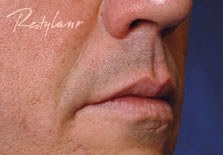 Restylane patient result
