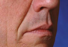 Before treatment result photograph