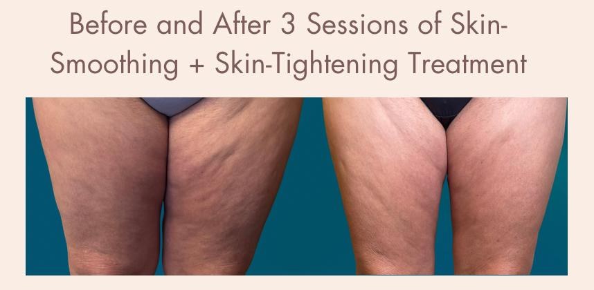 Before-and-after body contouring result 6