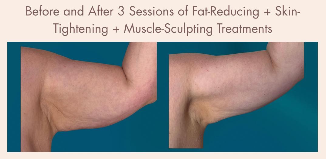 Before-and-after body contouring result 7