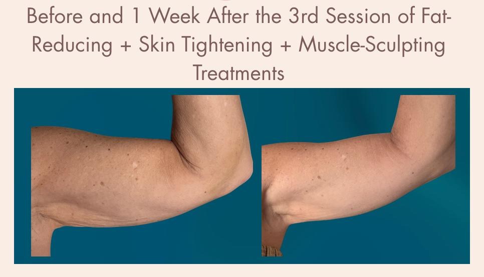 Before-and-after body contouring result 8