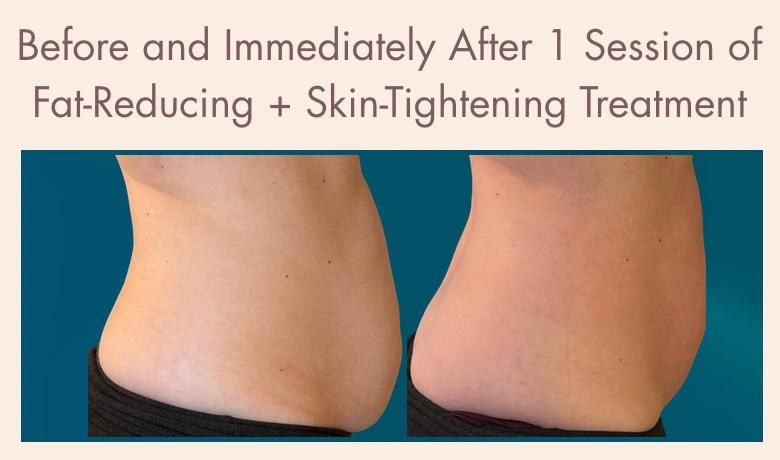 Clinical body contouring treatment result