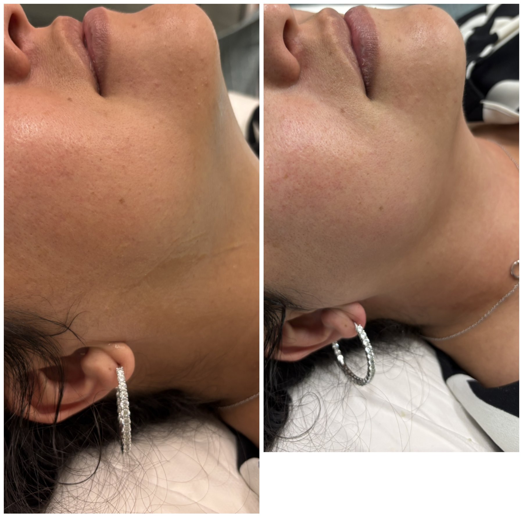 Side-by-side chin and jawline comparison photos