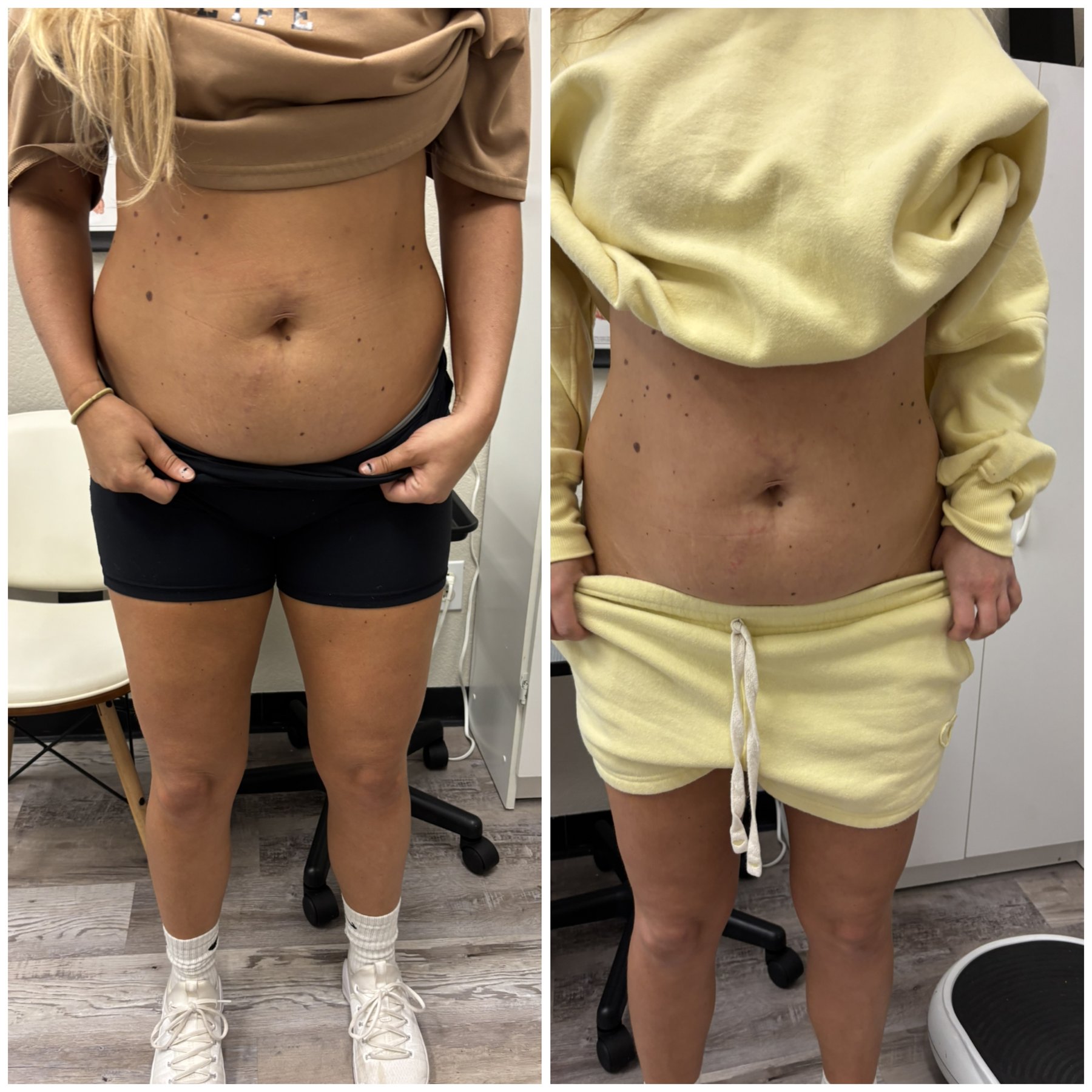 Front-view abdomen comparison photos