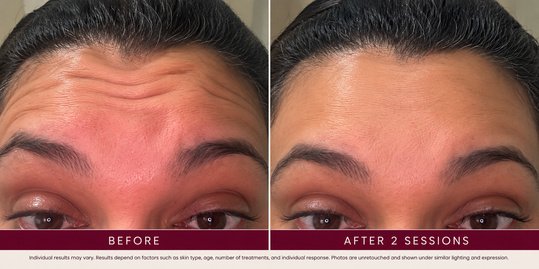 Before and after forehead photographs, labeled after two sessions.