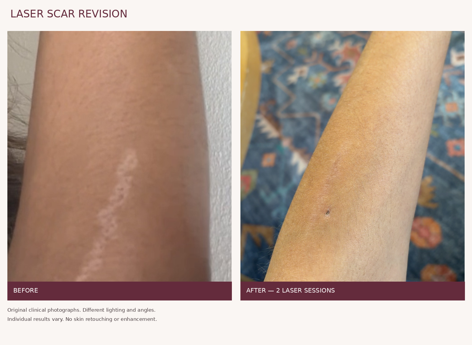 Original clinical photographs of an arm scar before and after two laser sessions. Lighting and angles differ; individual results vary.