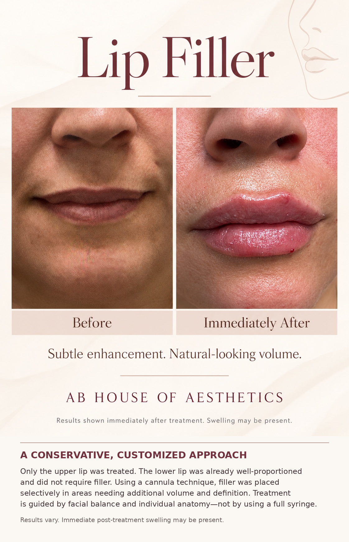 Upper lip filler comparison, before and immediately after treatment, with the clinical note and swelling disclosure.