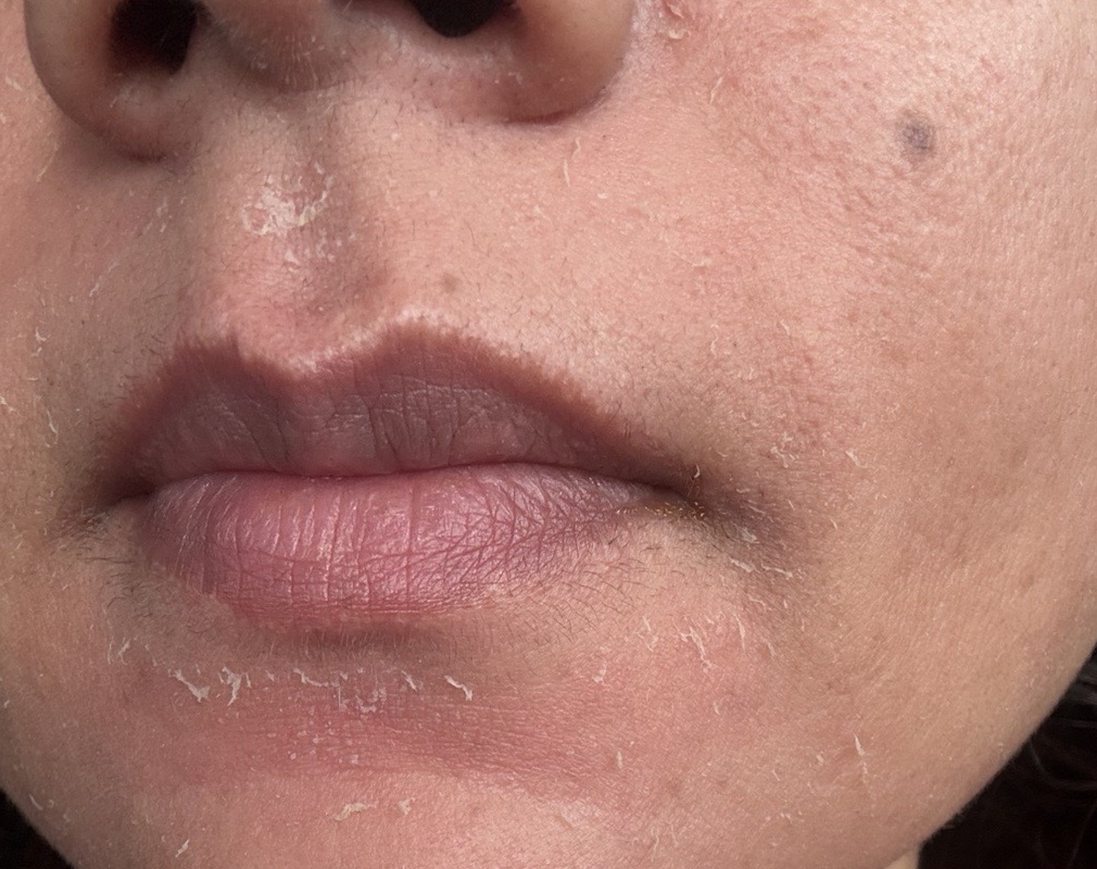 Skin with visible flaking and peeling, photographed three to four days after microneedling.