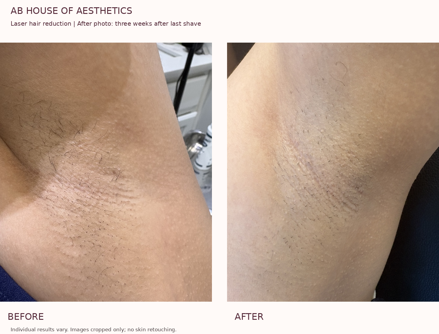 Before and after underarm laser hair reduction. After photo taken three weeks after the last shave.